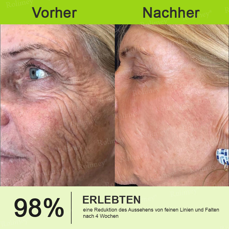 [Nur noch 30 MINUTEN] Jetzt jugendliche Haut zurückgewinnen Rolimey® Botox & Vita-A Retinol Shot Falten-Lift Straffungscreme