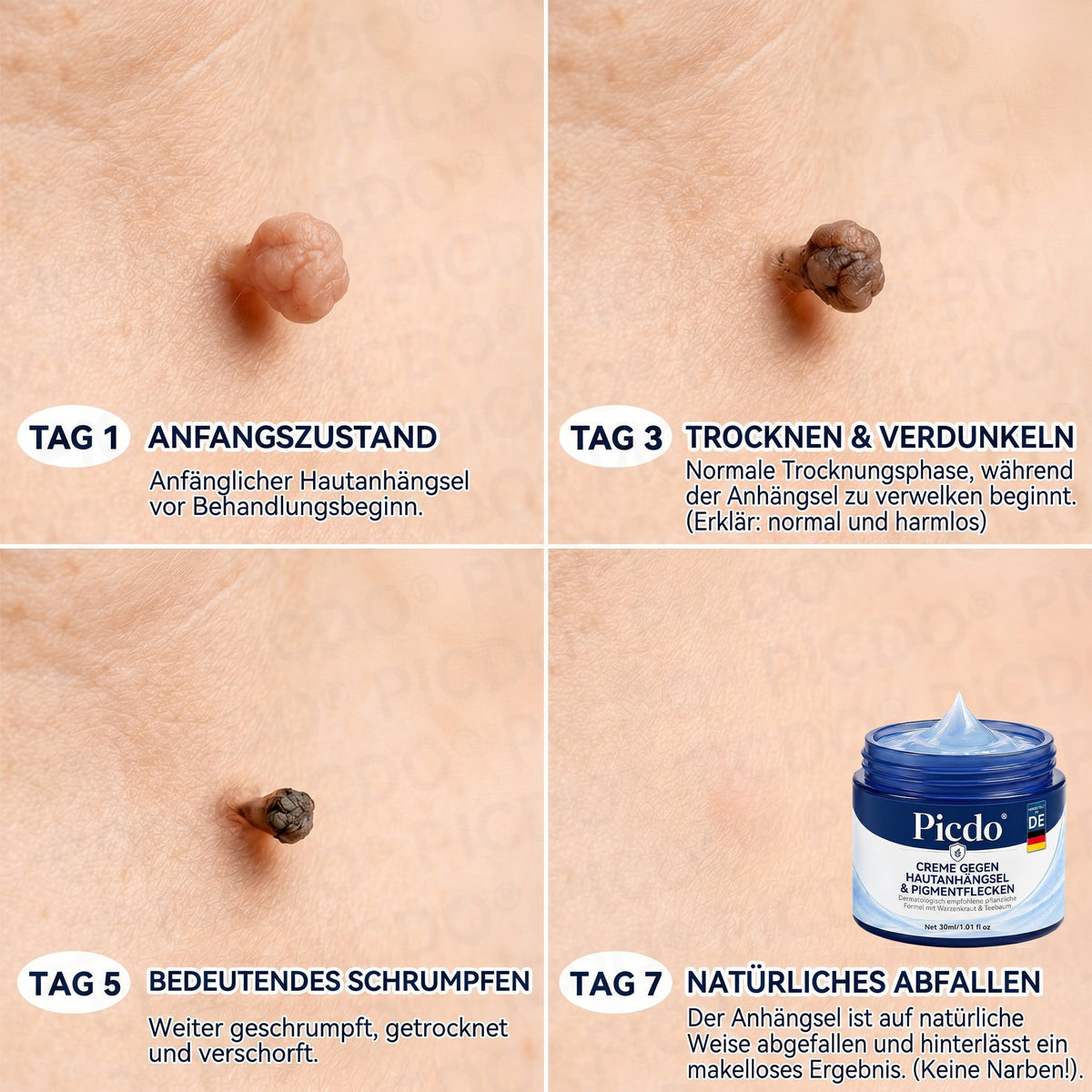 𝐏𝐢𝐜𝐝𝐨® 𝟕-𝐓𝐚𝐠𝐞 𝐇𝐚𝐮𝐭𝐚𝐧𝐡ä𝐧𝐠𝐬𝐞𝐥- & 𝐅𝐥𝐞𝐜𝐤𝐞𝐧-𝐄𝐧𝐭𝐟𝐞𝐫𝐧𝐮𝐧𝐠𝐬𝐜𝐫𝐞𝐦𝐞(𝐒𝐜𝐡𝐦𝐞𝐫𝐳𝐟𝐫𝐞𝐢𝐞 𝐅𝐨𝐫𝐦𝐞𝐥 – 𝐨𝐡𝐧𝐞 𝐍𝐚𝐫𝐛𝐞𝐧) 🎄