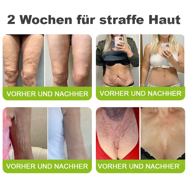 [Nur noch 30 MINUTEN] Jetzt jugendliche Haut zurückgewinnen Rolimey® Botox & Vita-A Retinol Shot Falten-Lift Straffungscreme