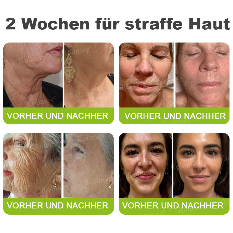 [Nur noch 30 MINUTEN] Jetzt jugendliche Haut zurückgewinnen Rolimey® Botox & Vita-A Retinol Shot Falten-Lift Straffungscreme